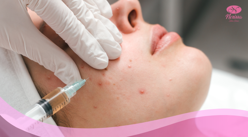 injeksi-acne-by-nerissa-skin-clinic-purwodadi-1