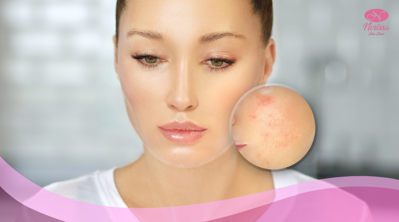 perawatan-kulit-sensitif-pie-post-inflammatory-erythema-di-nerissa-skin-clinic-purwodadi-grobogan