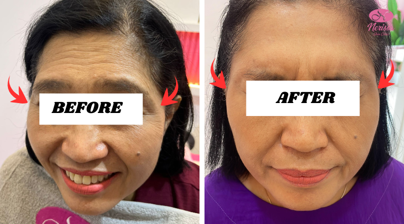 botox-cepat-murah-nerissa-skin-clinic-purwodadi-grobogan (2)