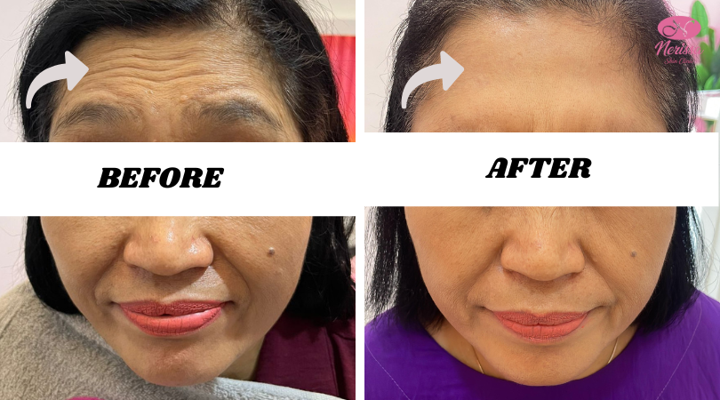 botox-cepat-murah-nerissa-skin-clinic-purwodadi-grobogan (3)