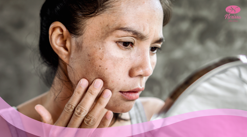 perbedaan-milia-tahi-lalat-kutil-dan-skin-tag-solusinya-treatment-cauter-ekstraksi-di-nerissa-skin-clinic-purwodadi-grobogan