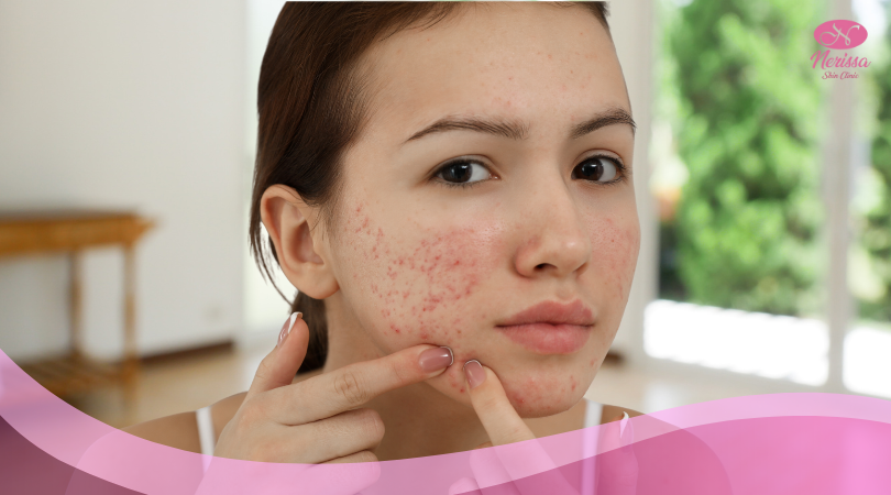 perawatan-bopeng-jerawat-scar-acne-nerissa-skin-clinic-purwodadi-grobogan