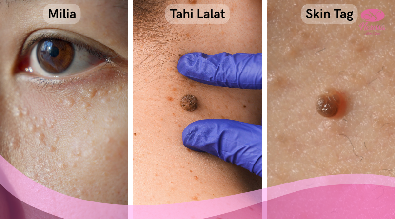 perbedaan-milia-tahi-lalat-dan-skin-tag-solusinya-treatment-cauter-ekstraksi-di-nerissa-skin-clinic-purwodadi-grobogan-1