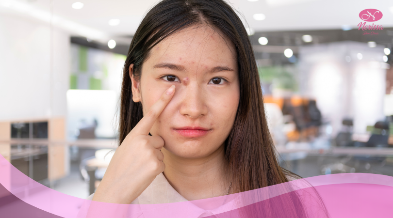 treatment-dan-produk-jerawat-acne-aktif-di-nerissa-skin-clinic-purwodadi-grobogan