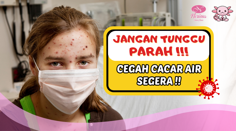 ayo-cegah-penularan-cacar-air-vaksin-varicella-di-nerissa-skin-clinic-purwodadi-grobogan