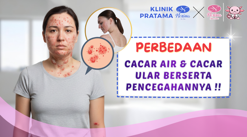 perbedaan-vaksinasi-untuk-cacar-air-varicella-dan-cacar-ular-zoster-di-klinik-pratama-nerissa-skin-clinic-purwodadi-grobogan